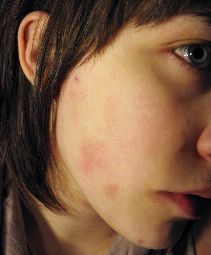Видалення прищів, плям на шкірі обличчя за допомогою Фотошоп